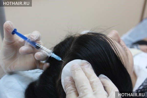 Сравнение плазмолифтинга и мезотерапии волос
