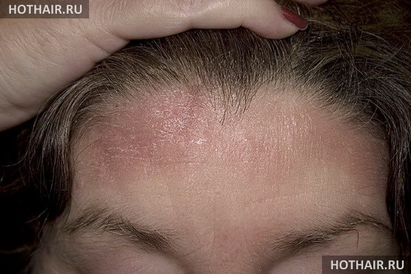 Чем лечится себорейный дерматит волосистой части головы thumbnail