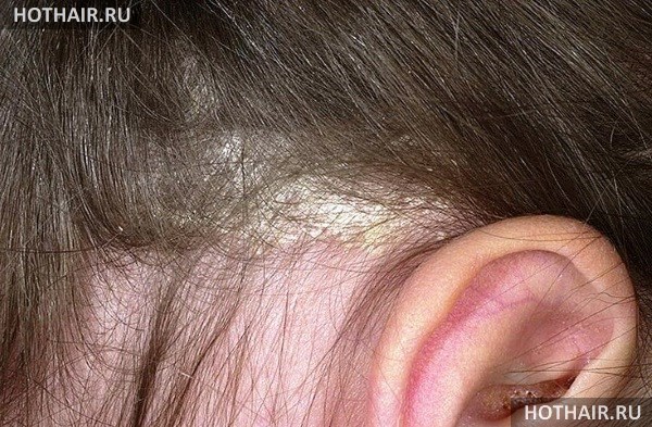 Как вылечить себорейный дерматит волосистой части головы thumbnail