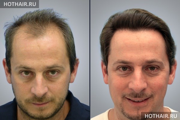 Пересадка волос