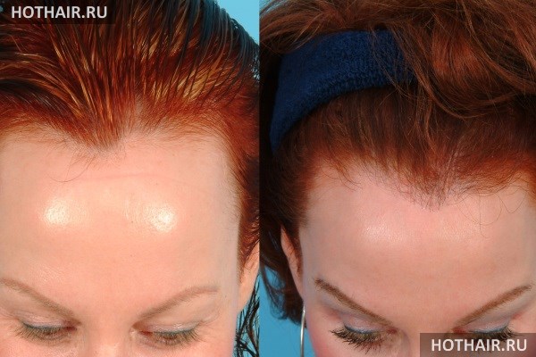 Пересадка волос