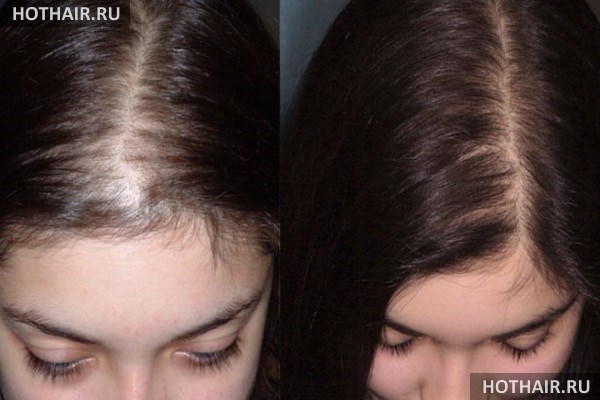 Пересадка волос