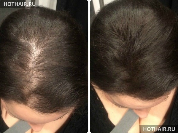 Пересадка волос