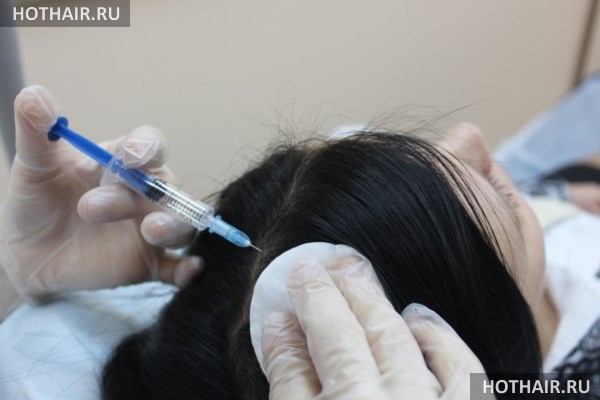 Что лучше для кожи головы мезотерапия или плазмолифтинг Что лучше для кожи головы мезотерапия или плазмолифтинг thumbnail