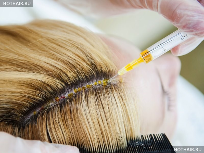 Сравнение плазмолифтинга и мезотерапии волос